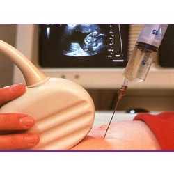 تشخیص ناهنجاری کروموزومی به کمک آزمایش آمنیوسنتز